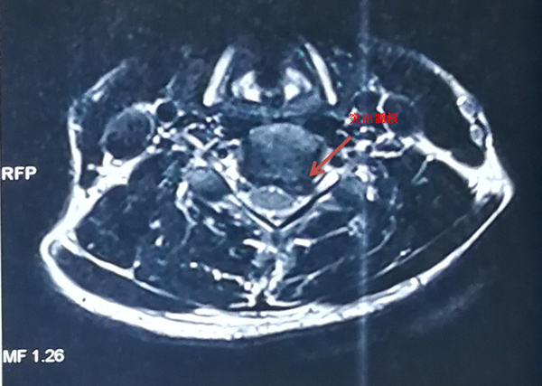 图片1 手术前MRI_副本.png