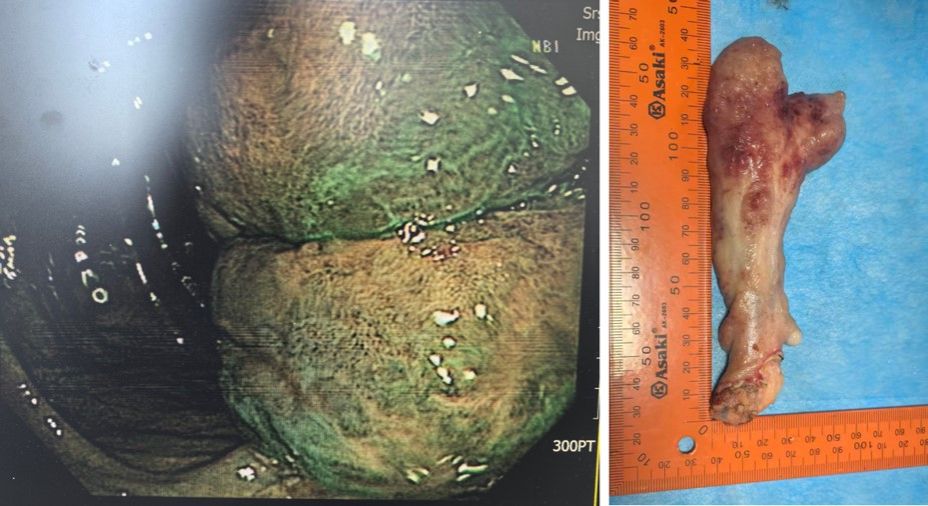 巨大肿物原.jpg 巨大肿物原.jpg