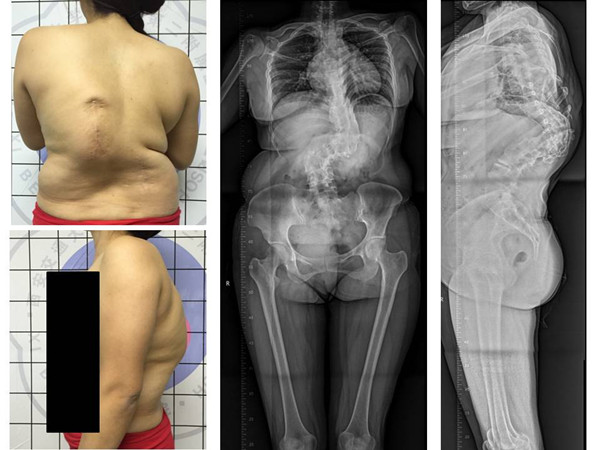 图1 术前外观照及X线正侧位_副本.jpg