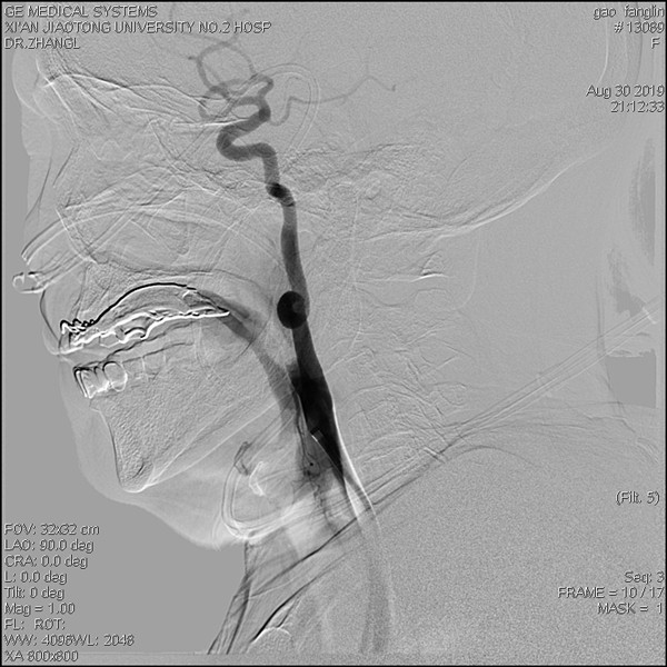 取栓术后颈内动脉内血栓消失_副本.jpg 取栓术后颈内动脉内血栓消失_副本.jpg