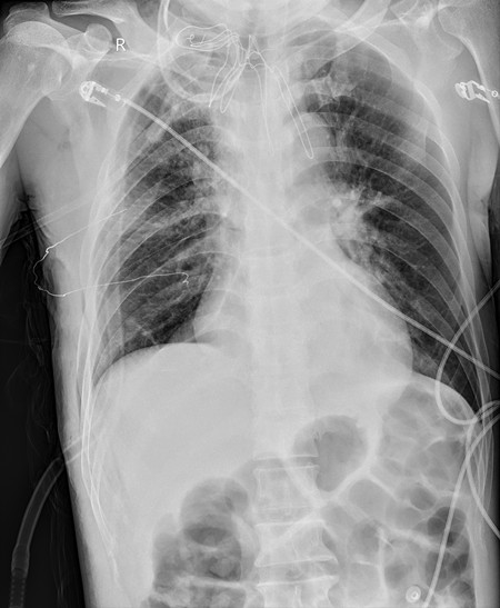 术后胸片_副本.jpg 术后胸片_副本.jpg