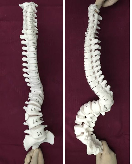 图3 应用3D打印脊柱模型辅助手术_副本.jpg