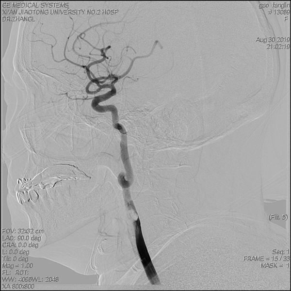 造影见右侧颈内动脉起始段内大量血栓_副本.jpg 造影见右侧颈内动脉起始段内大量血栓_副本.jpg