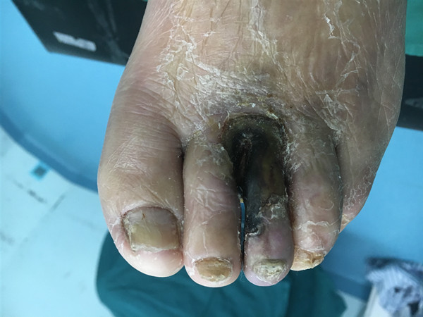 图1 患者坏死足趾_副本.jpg