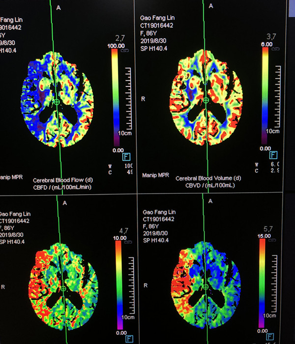 术前CTP提示右侧颈内动脉分布区血流减少_副本.jpg 术前CTP提示右侧颈内动脉分布区血流减少_副本.jpg