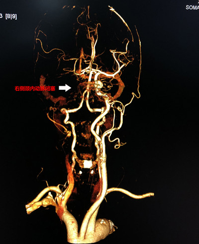 术前CTA见右侧颈内动脉闭塞_副本.jpg 术前CTA见右侧颈内动脉闭塞_副本.jpg