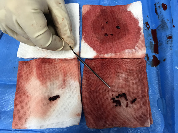 取出的血栓_副本.jpg 取出的血栓_副本.jpg